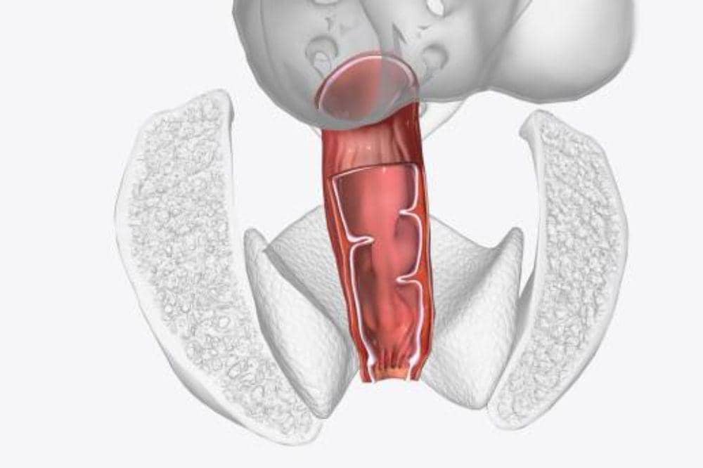 8 Penyebab Hernia Inguinalis pada Perempuan dan Faktor Resiko Utamanya