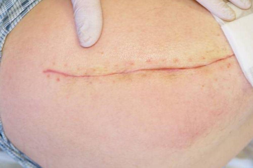 8 Penyebab Hernia Inguinalis pada Perempuan dan Faktor Resiko Utamanya