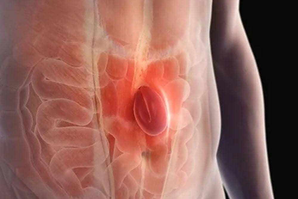 Apa yang Terjadi Jika Hernia Dibiarkan Bisa Mengancam Nyawa (1).jpg