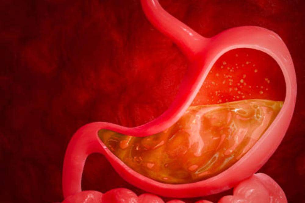 Apa Itu Hernia Hiatus? Kenali Kondisinya yang Sering Disalahartikan!