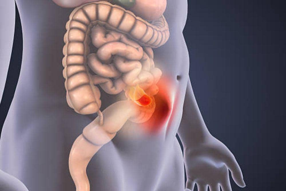 9 Penyebab Hernia Hiatus yang Bisa Dialami Siapa Saja