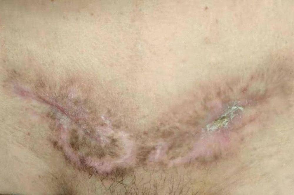 4 Tanda Operasi Hernia yang Gagal, Kenali Agar Cepat Ditangani.jpg