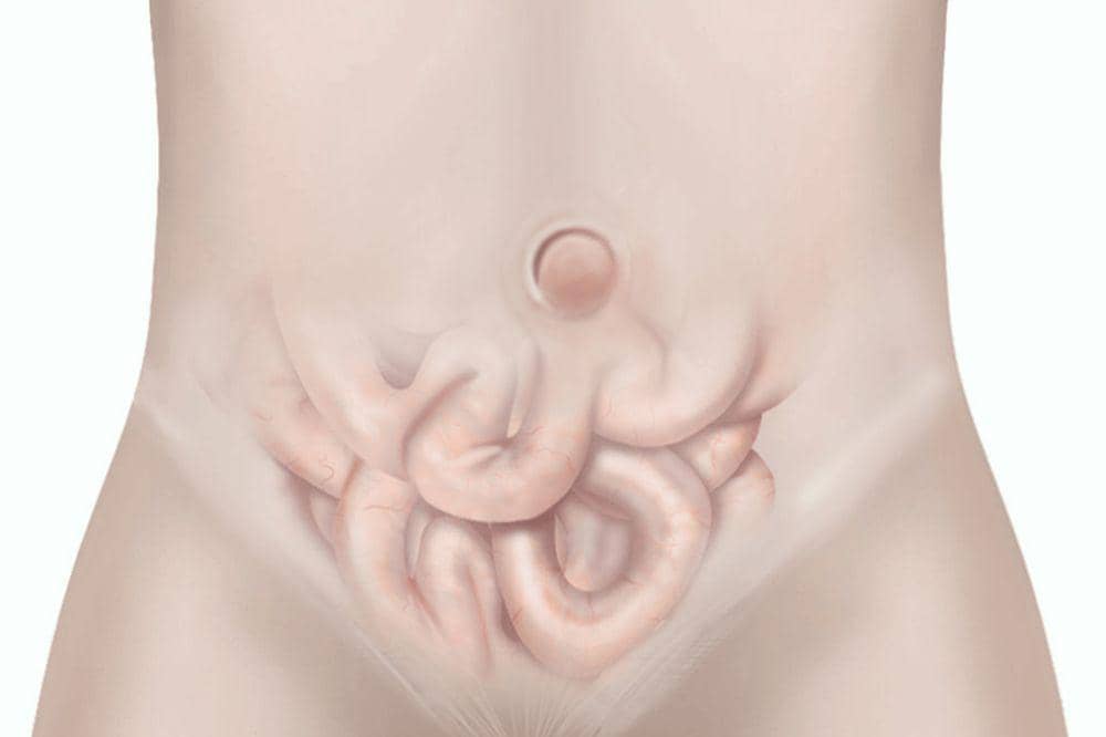 Apa Itu Hernia Umbilikalis Benjolan di Pusar Bisa Jadi Tanda Ini (2).jpg