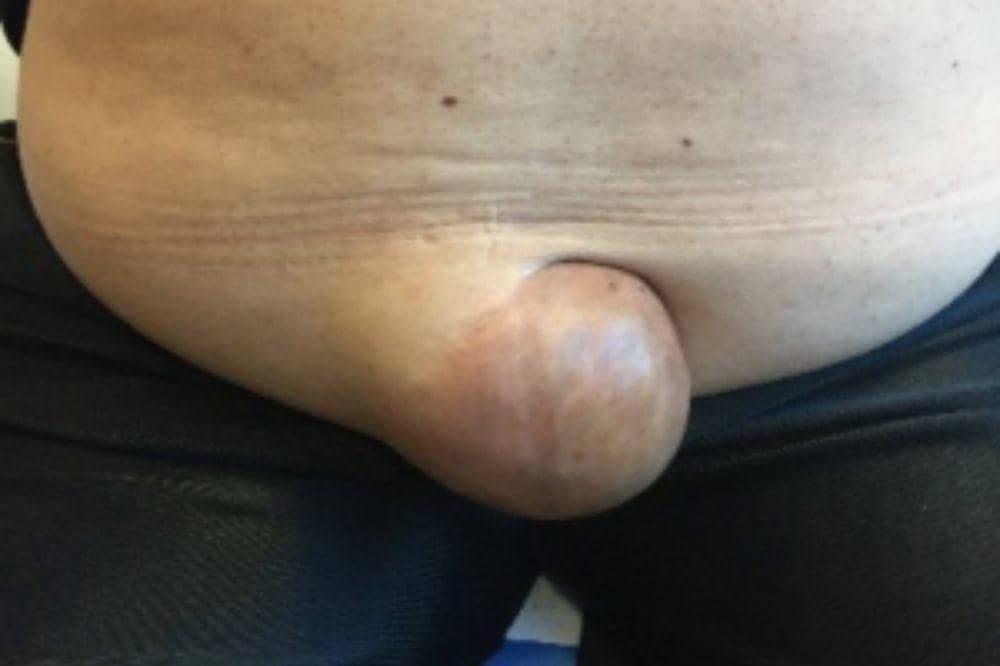 5 Ciri-Ciri Hernia Umbilikalis pada Dewasa yang Wajib Dikenali (1).jpg