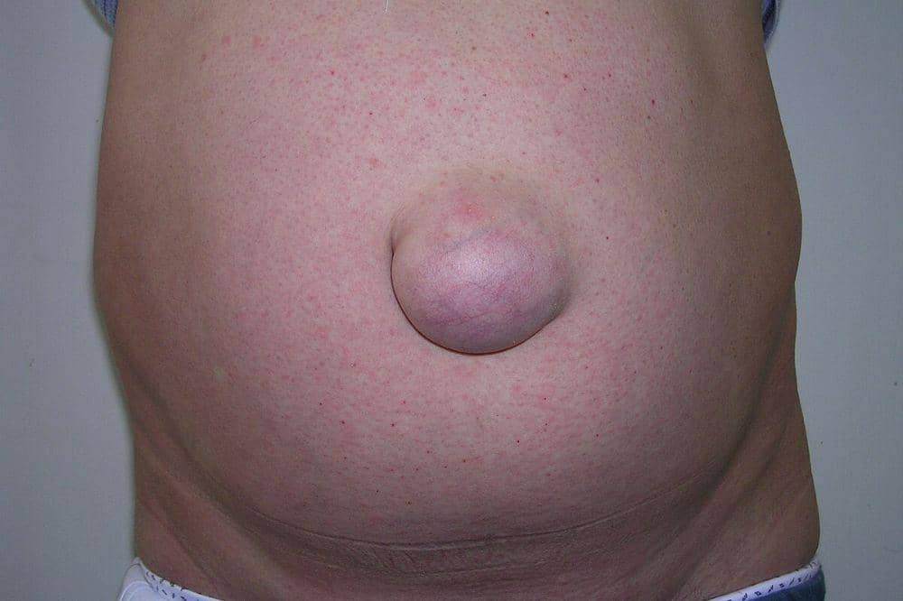 Apa Itu Hernia Umbilikalis Benjolan di Pusar Bisa Jadi Tanda Ini.jpg