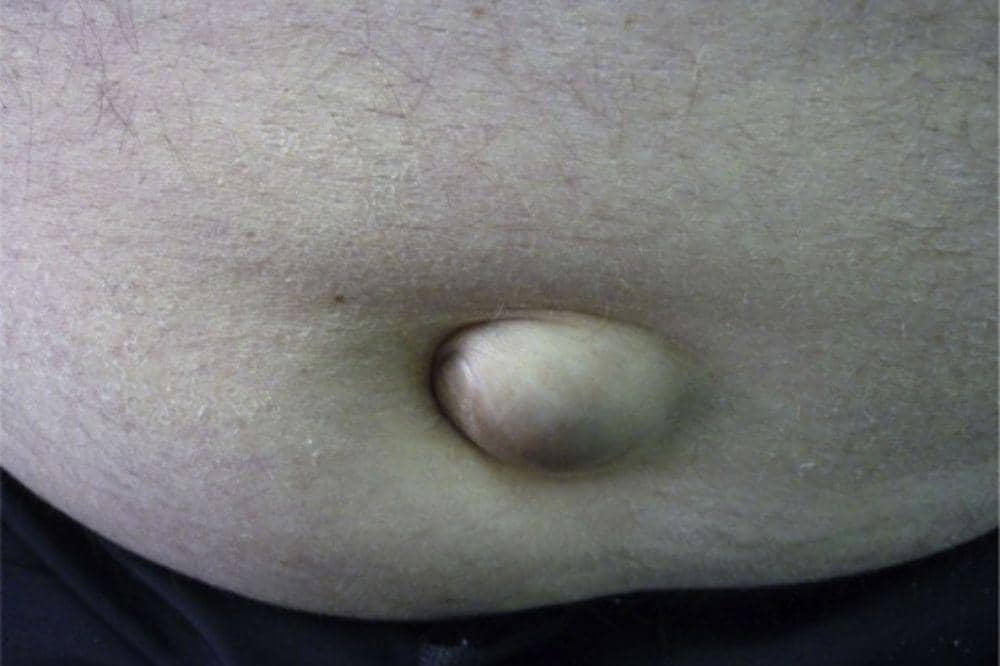 5 Ciri-Ciri Hernia Umbilikalis pada Dewasa yang Wajib Dikenali.jpg