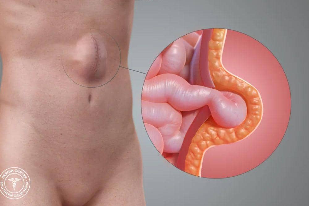 Apa Itu Hernia Insisional Waspadai Benjolan di Bekas Operasi (1).jpg