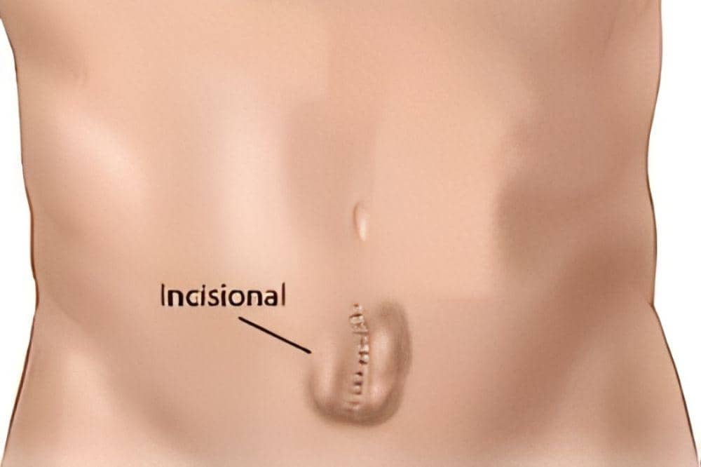 Apa Itu Hernia Insisional Waspadai Benjolan di Bekas Operasi.jpg