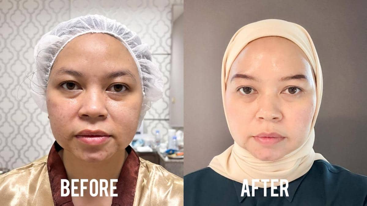 before after treatment Miracle Densilift 