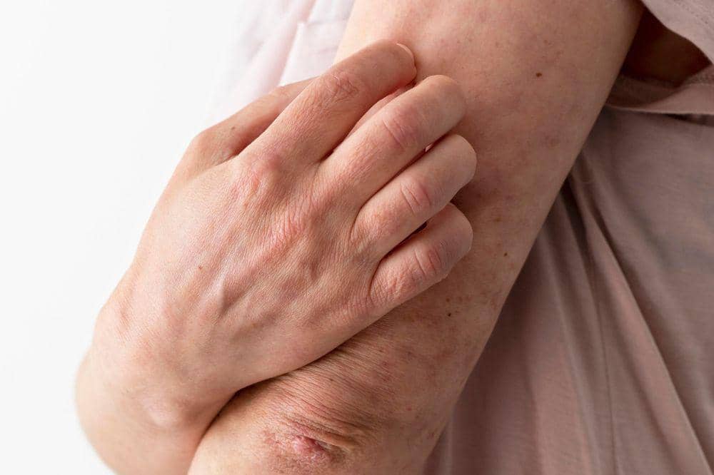 4 Ciri-Ciri Eksim yang Mau Sembuh, Perhatikan Perubahan pada Kulit (3).jpg