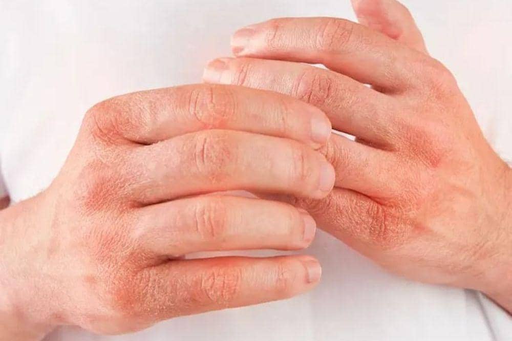  6 Cara Menyembuhkan Eksim Secara Total, Apakah Bisa?