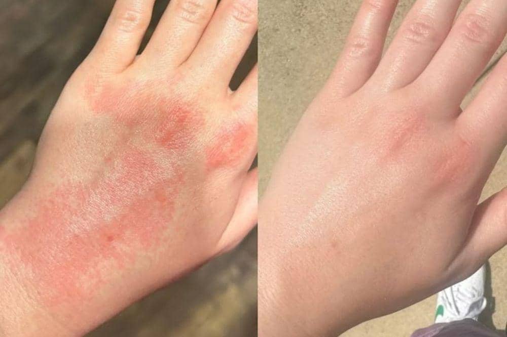 Apa Itu Eksim? Masalah Kulit Kronis yang Perlu Dipahami