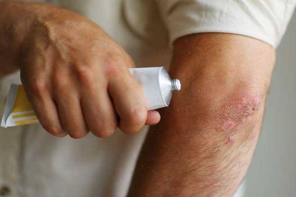 Apa Itu Eksim? Masalah Kulit Kronis yang Perlu Dipahami