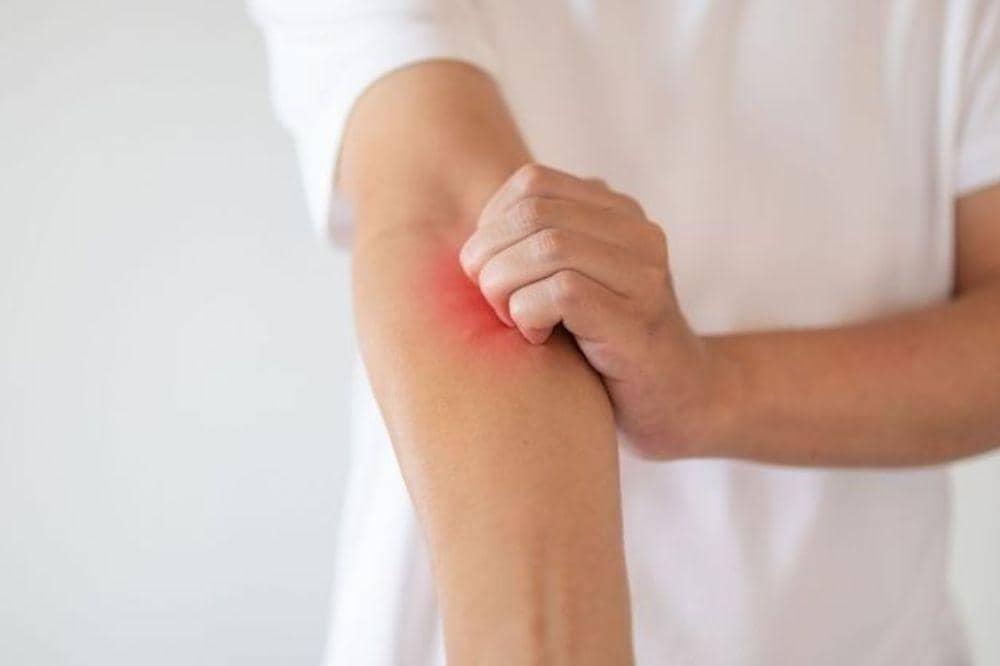 6 Cara Menyembuhkan Eksim Secara Total, Apakah Bisa?