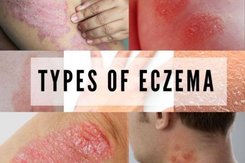 Apa Itu Eksim? Masalah Kulit Kronis yang Perlu Dipahami