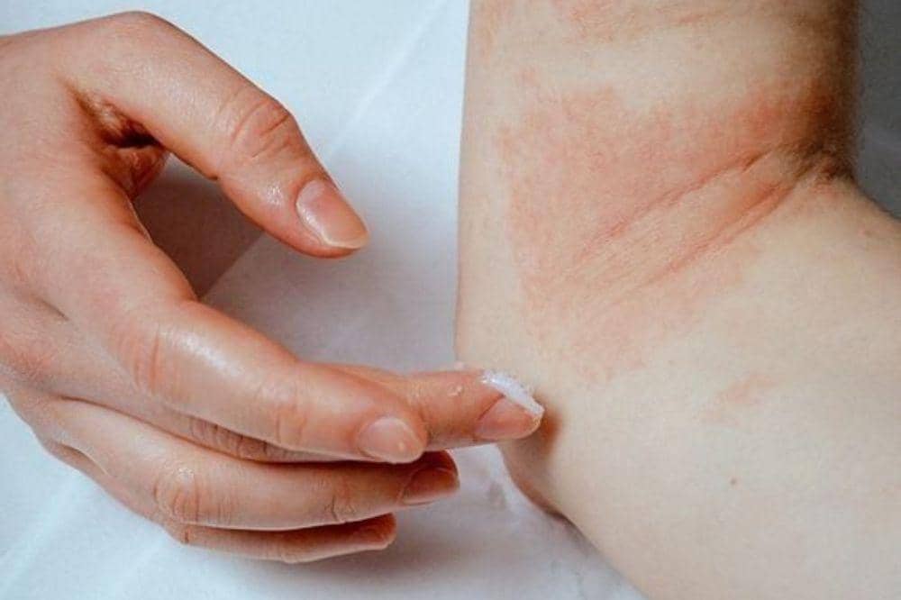 5 Penyebab Eksim yang Terlihat Sepele, Namun Beresiko!