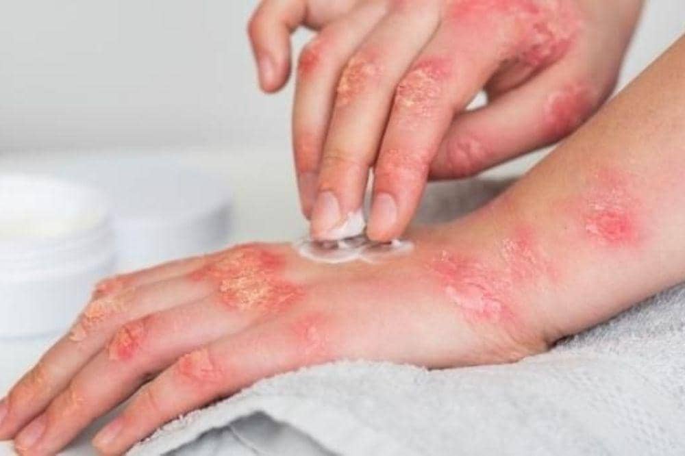 5 Perbedaan Eksim Basah dan Kering, Mana yang Lebih Berbahaya?