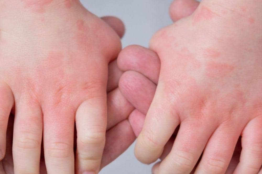 Apa Itu Eksim? Masalah Kulit Kronis yang Perlu Dipahami