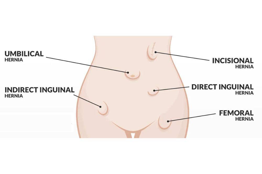 hernia umbilical