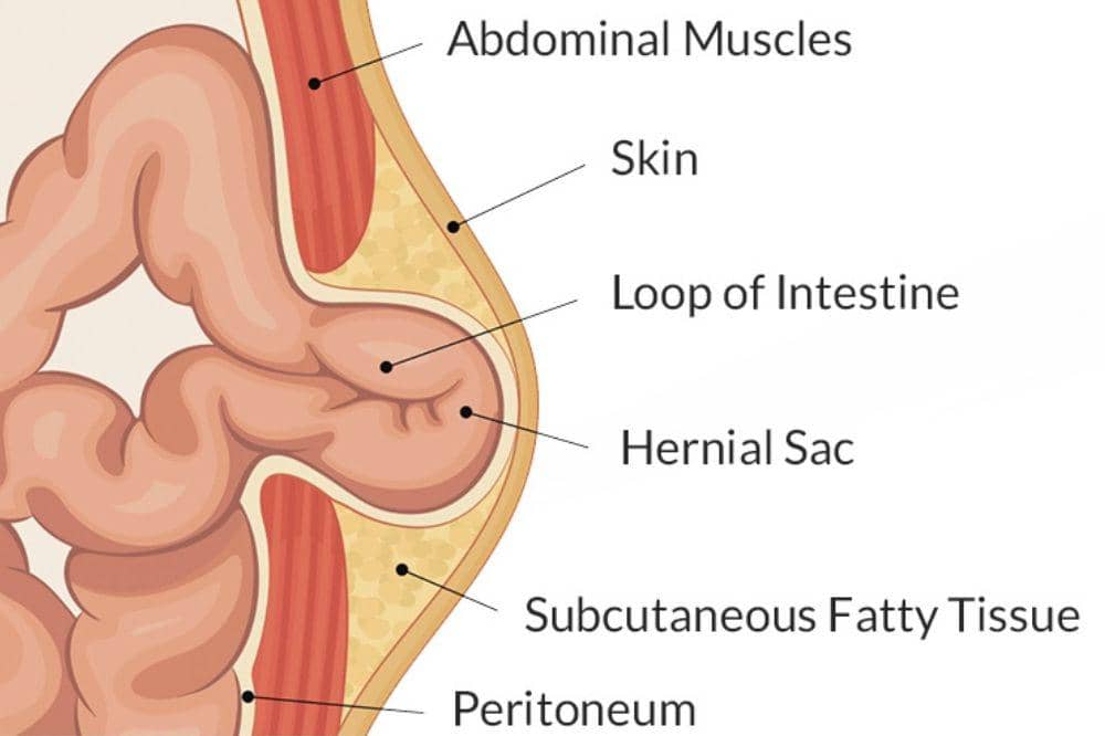 hernia umbilikal anak