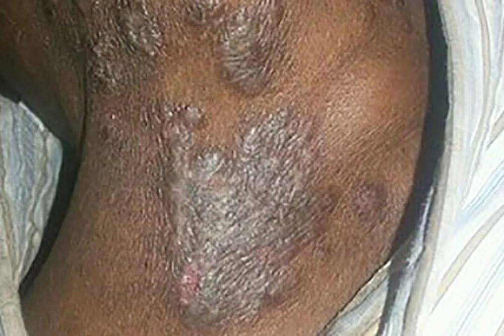 6 Gejala Eksim di Leher, Bisa Mengganggu Aktivitas Sehari-hari (4).jpg