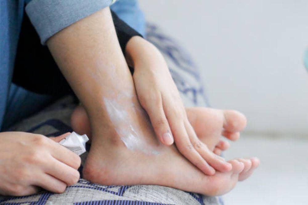7 Cara Mengatasi Eksim Kering di Kaki yang Gatal dan Pecah-Pecah