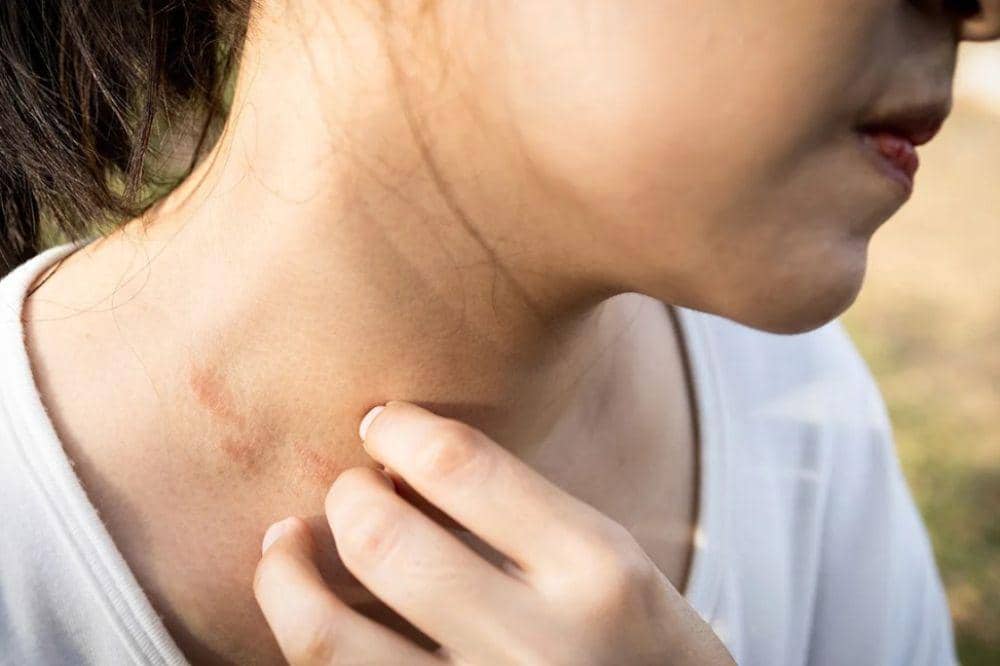 6 Gejala Eksim di Leher, Bisa Mengganggu Aktivitas Sehari-hari (3).jpg