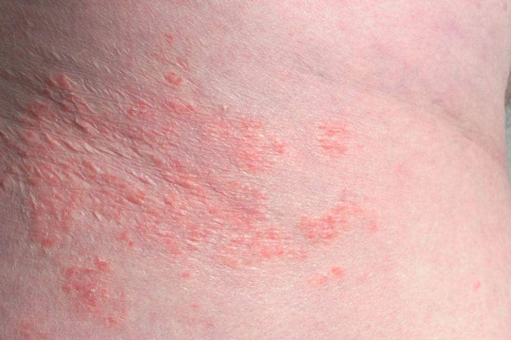 6 Gejala Eksim di Leher, Bisa Mengganggu Aktivitas Sehari-hari (1).jpg