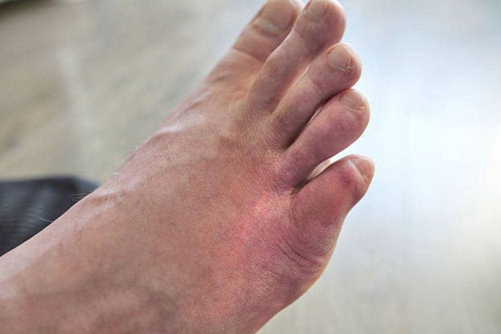 7 Ciri-Ciri Eksim Kering di Telapak Kaki, Sering Disangka Kulit Biasa