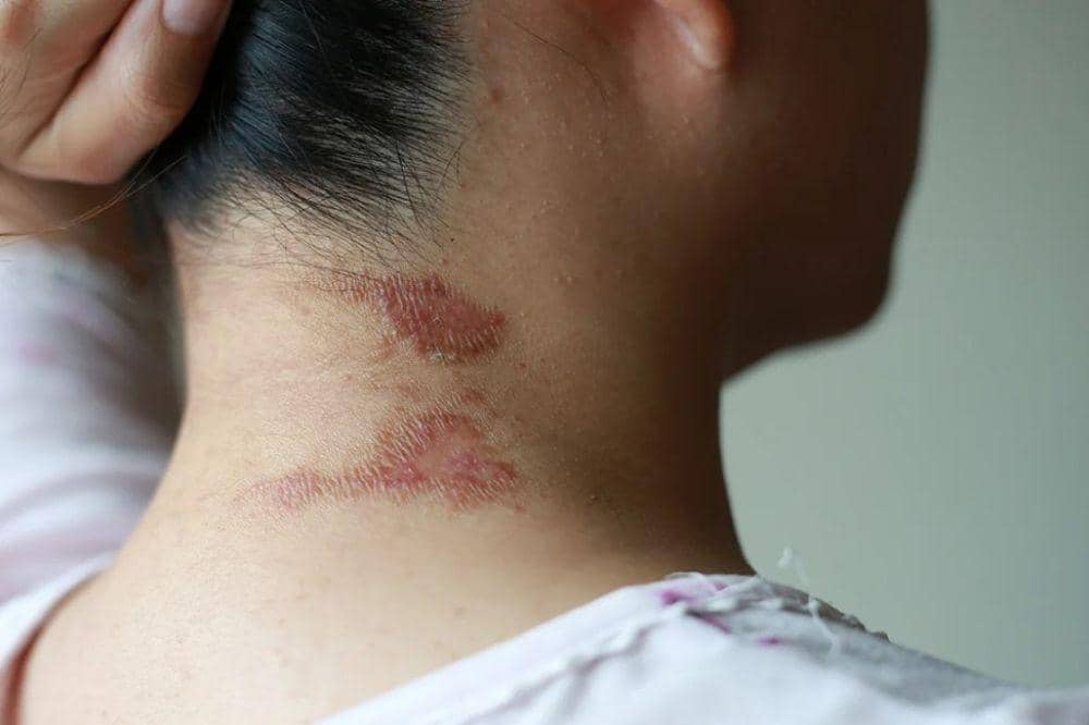 6 Gejala Eksim di Leher, Bisa Mengganggu Aktivitas Sehari-hari (2).jpg