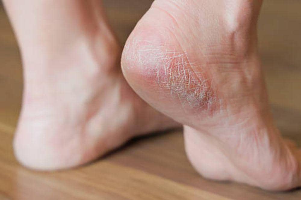 7 Ciri-Ciri Eksim Kering di Telapak Kaki, Sering Disangka Kulit Biasa