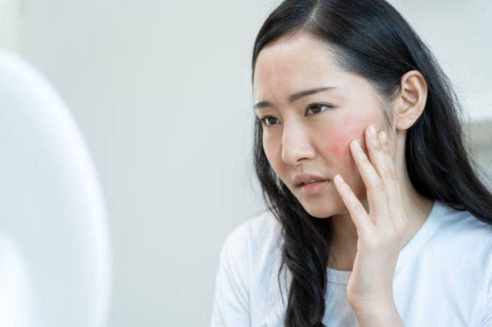 5 Perbedaan Eksim Basah dan Kering, Mana yang Lebih Berbahaya?