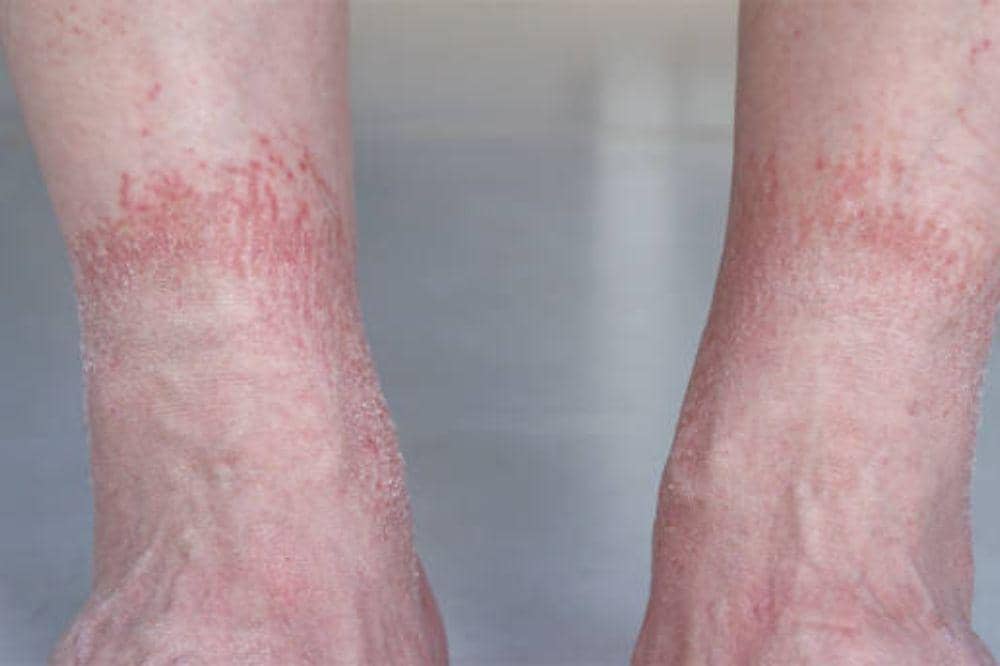 7 Cara Mengatasi Eksim Kering di Kaki yang Gatal dan Pecah-Pecah