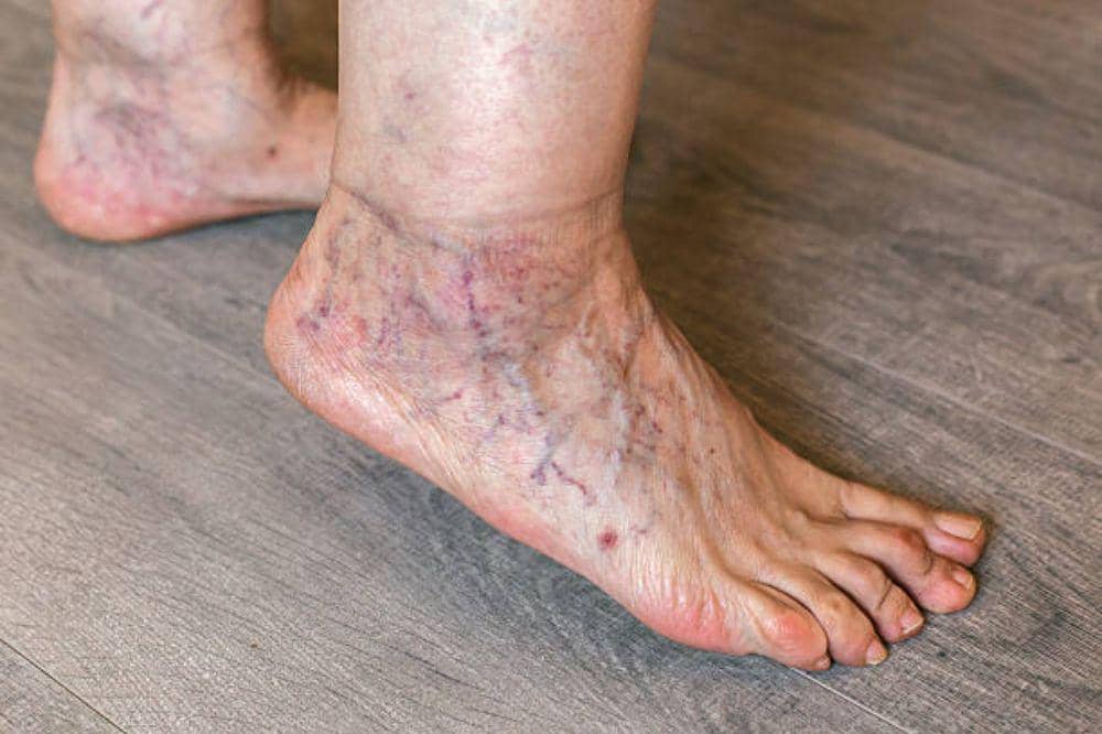 7 Ciri-Ciri Eksim Kering di Telapak Kaki, Sering Disangka Kulit Biasa