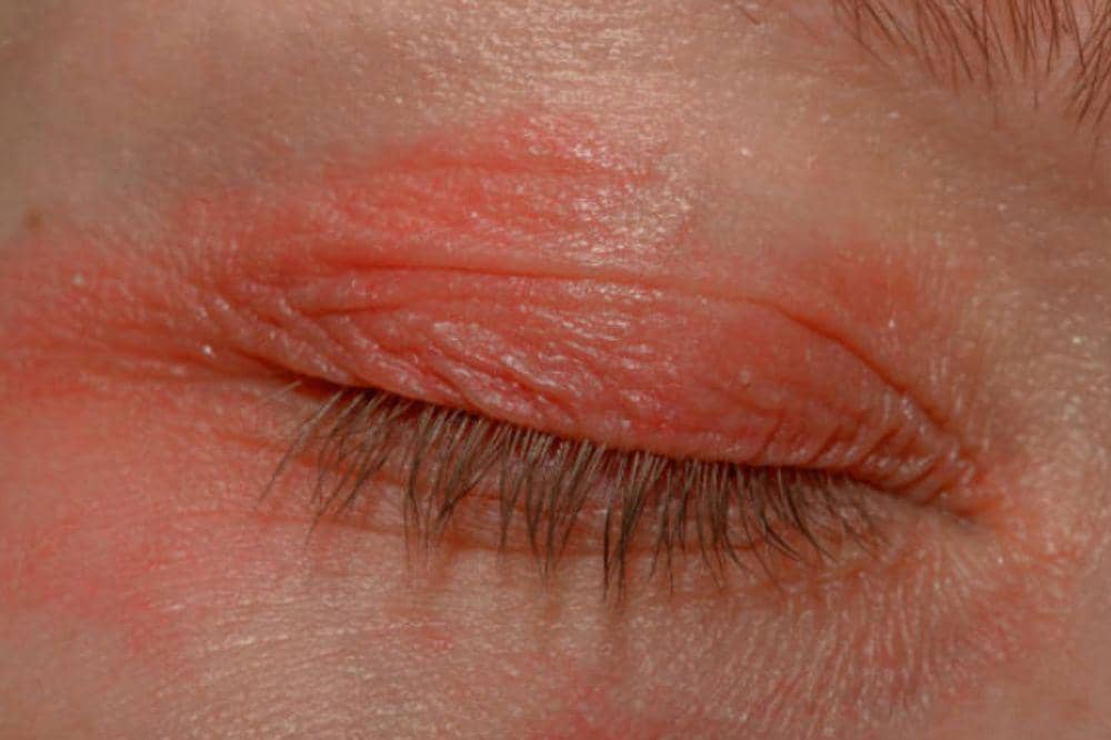 7 Penyebab Eksim di Kelopak Mata yang Diam-diam Memicu Kambuh