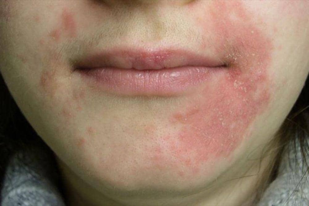 Apakah Eksim Menular? Jangan Salah Paham, Ini Penjelasannya.jpg