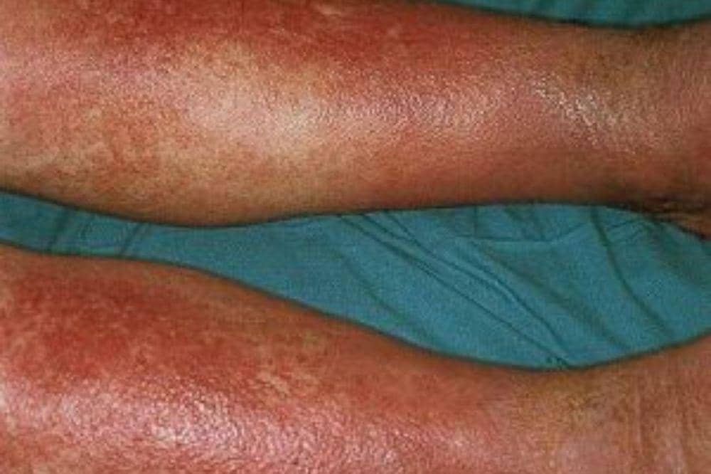 6 Penyebab Eksim di Kaki, Ketahui agar Lebih Mudah Mencegahnya (2).jpg