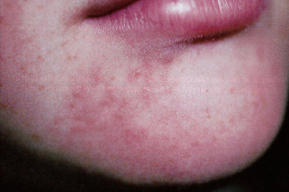 5 Gejala Eksim di Wajah, Bisa Menganggu Penampilan (3).jpg