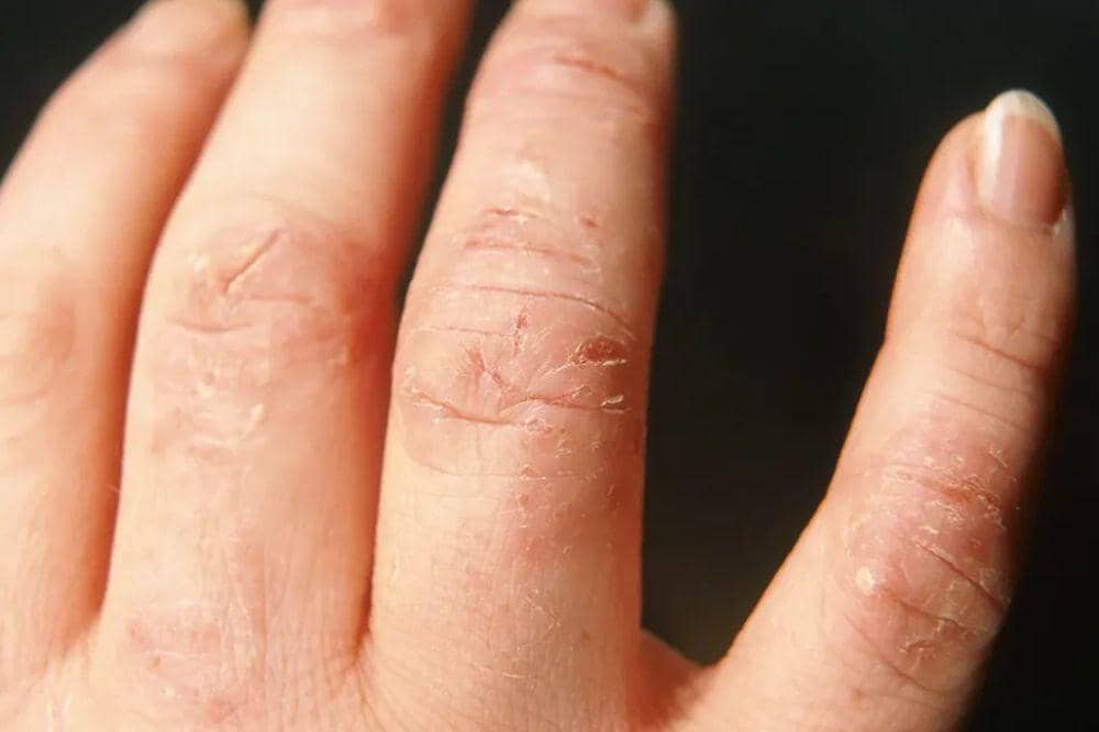 6 Contoh Eksim Kering yang Sering Muncul di Berbagai Area Tubuh.jpg