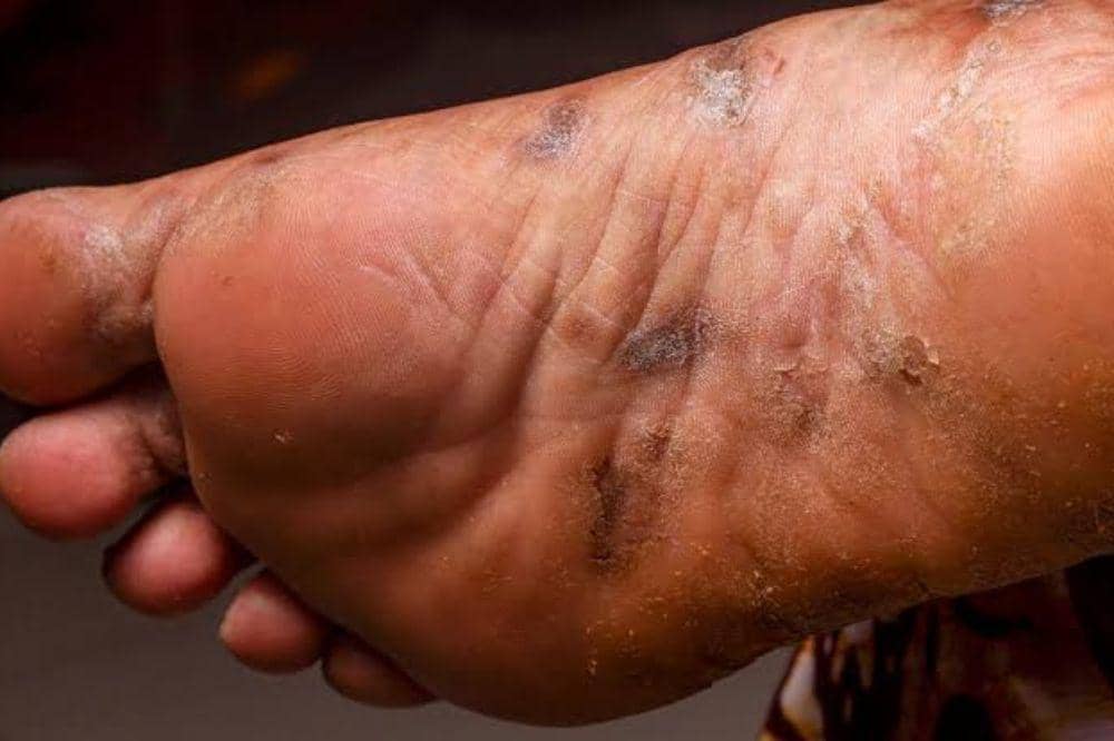 5 Cara Mengobati Eksim Basah di Kaki agar Tidak Semakin Parah.jpg