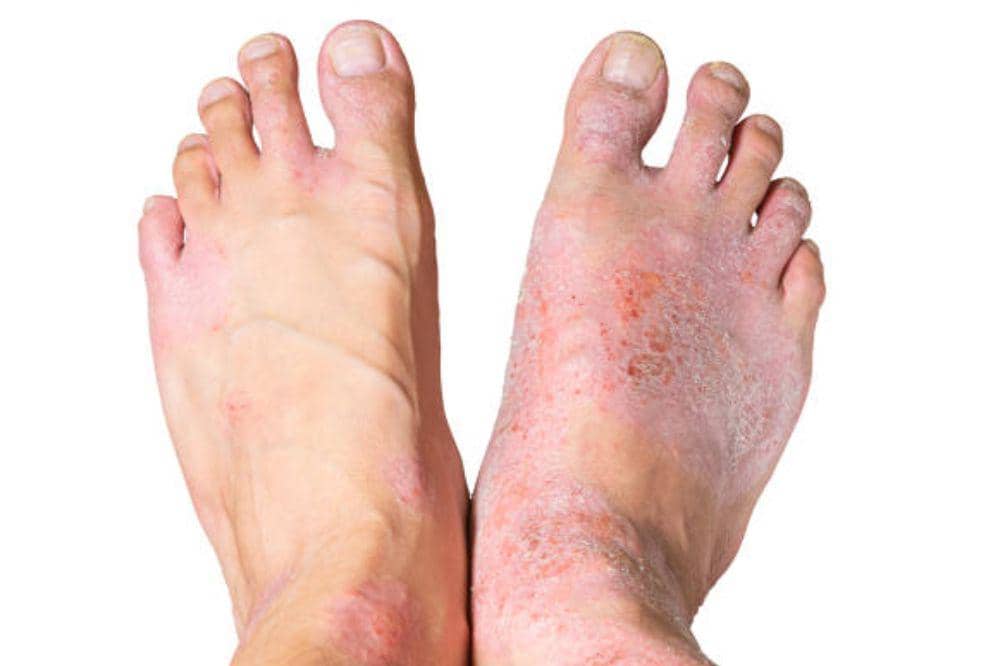 Eksim Basah di Kaki, Apakah Menular? Ini Cara Mencegahnya