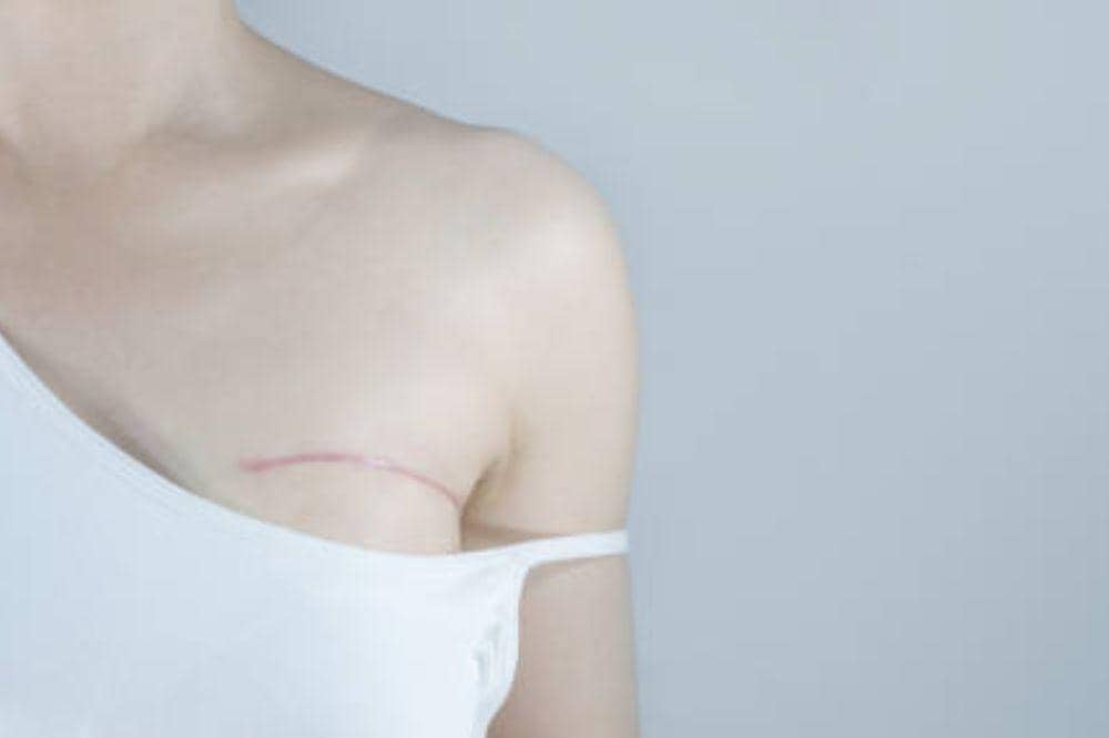 Kanker Payudara Stadium 4: Gejala Lanjut dan Upaya Penanganan