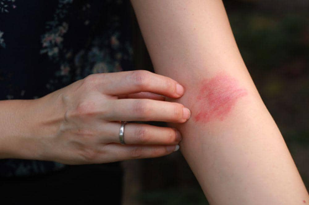 8 Penyebab Eksim Basah yang Perlu Dipahami Secara Mendalam