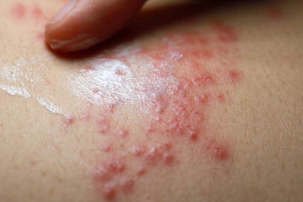 8 Ciri-Ciri Eksim Basah yang Sering Disalahartikan