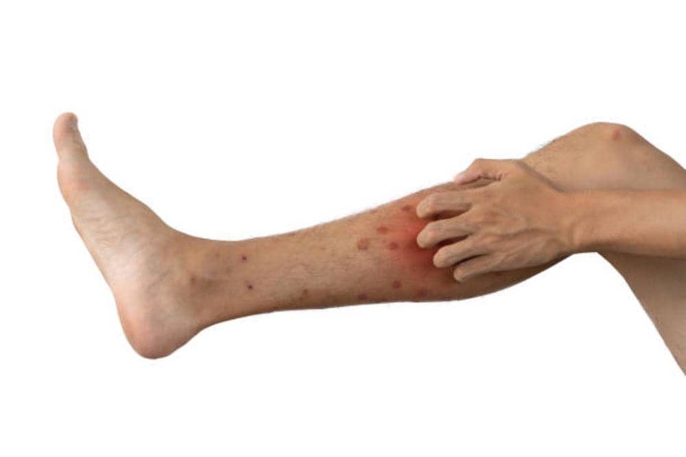 Eksim Basah di Kaki, Apakah Menular? Ini Cara Mencegahnya