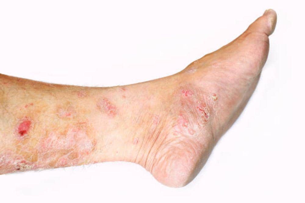 Eksim Basah di Kaki, Apakah Menular? Ini Cara Mencegahnya