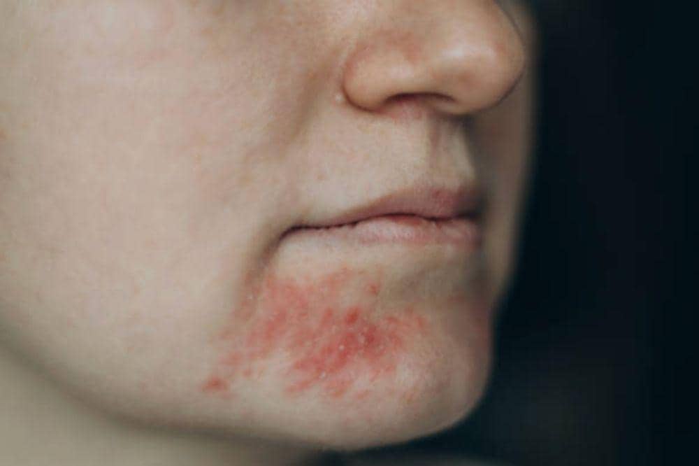 8 Ciri-Ciri Eksim Basah yang Sering Disalahartikan