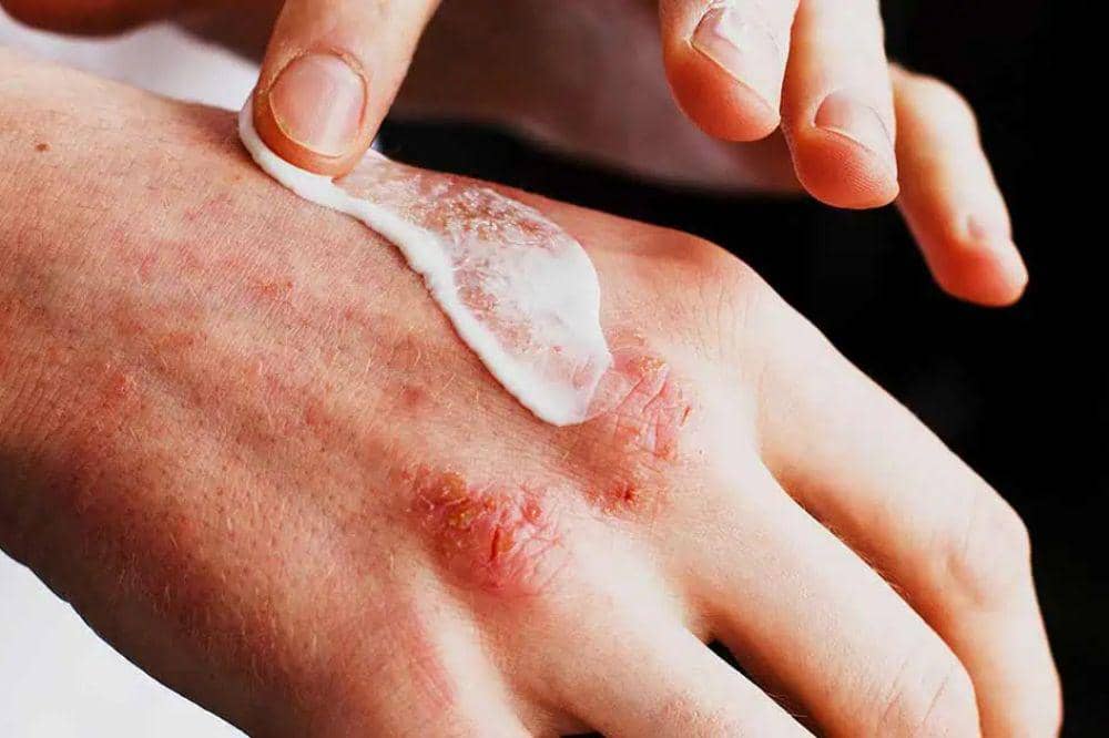 Apa Itu Eksim Basah Jangan Abaikan Kulit yang Mengeluarkan Cairan.jpg