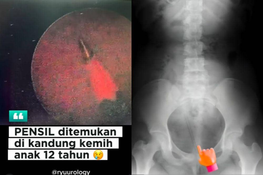 kasus dr. ryuu temukan pensil di kandung kemih anak 12 tahun