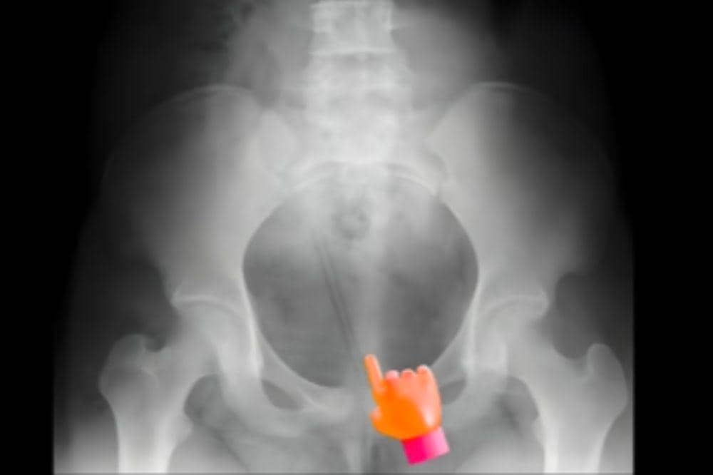 kasus dr. ryuu temukan pensil di kandung kemih anak 12 tahun